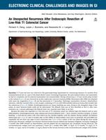 An Unexpected Recurrence After Endoscopic Resection of Low-Risk T1 Colorectal Cancer
