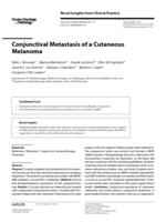 Conjunctival Metastasis of a Cutaneous Melanoma
