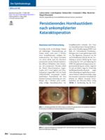 Persisting corneal edema after uncomplicated cataract surgery