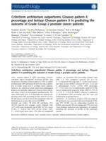 Cribriform architecture outperforms Gleason pattern 4 percentage and tertiary Gleason pattern 5 in predicting the outcome of Grade Group 2 prostate cancer patients