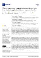 Features on endoscopy and MRI after treatment with contact X-ray brachytherapy for rectal cancer