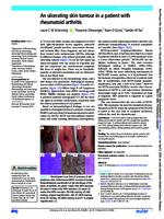 An ulcerating skin tumour in a patient with rheumatoid arthritis